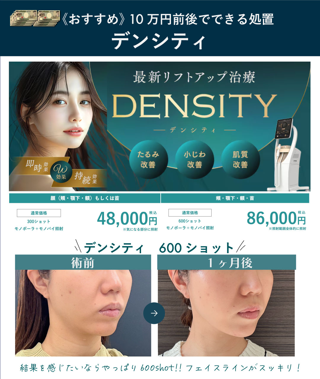 【リフトアップ】デンシティ
