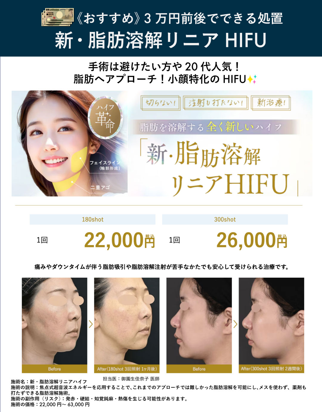 【小顔】新・脂肪溶解リニアHIFU