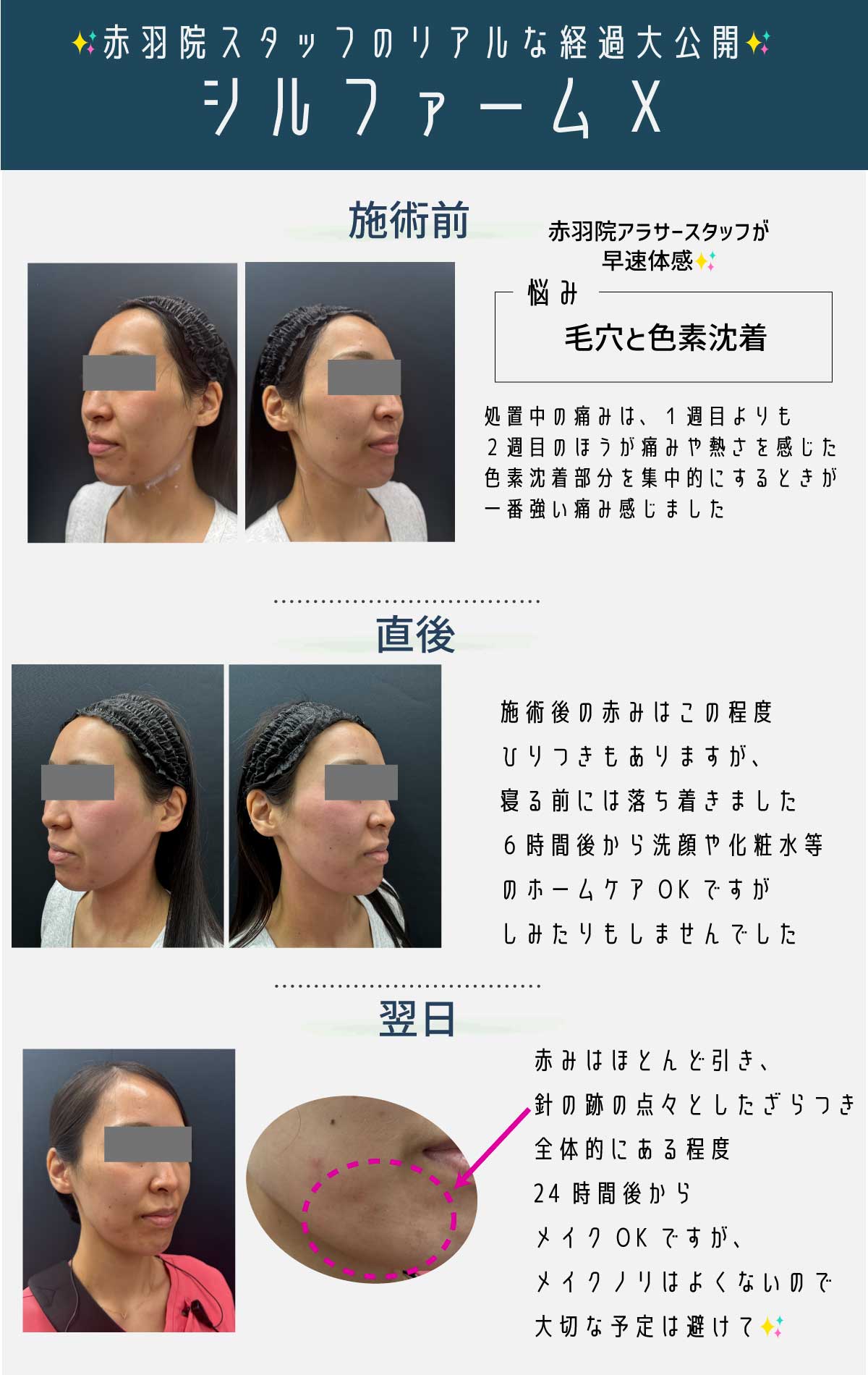 【スタッフレポート】シルファームのリアルな経過《施術前➡︎翌日》