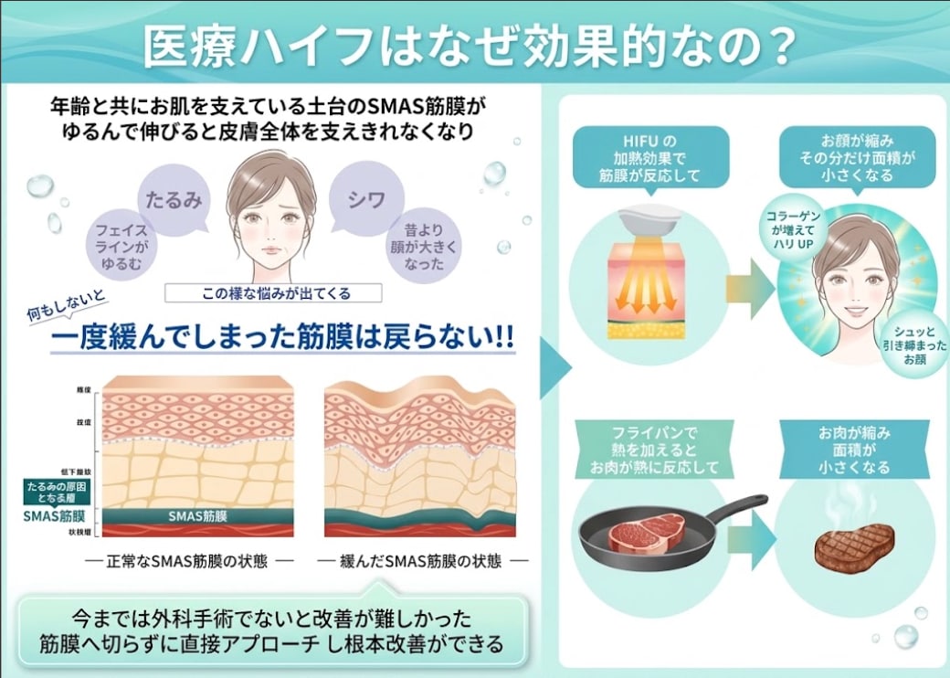 【まずは基本】医療ハイフの効果と従来機器との仕組みの違い