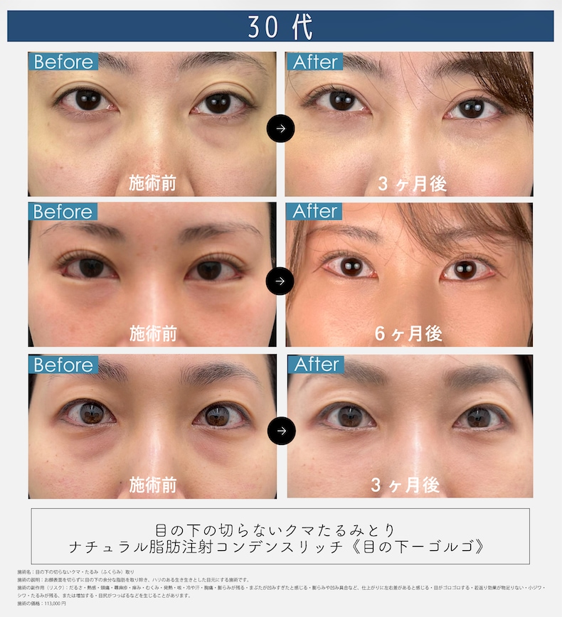 📸30代のクマ取り症例写真📸
