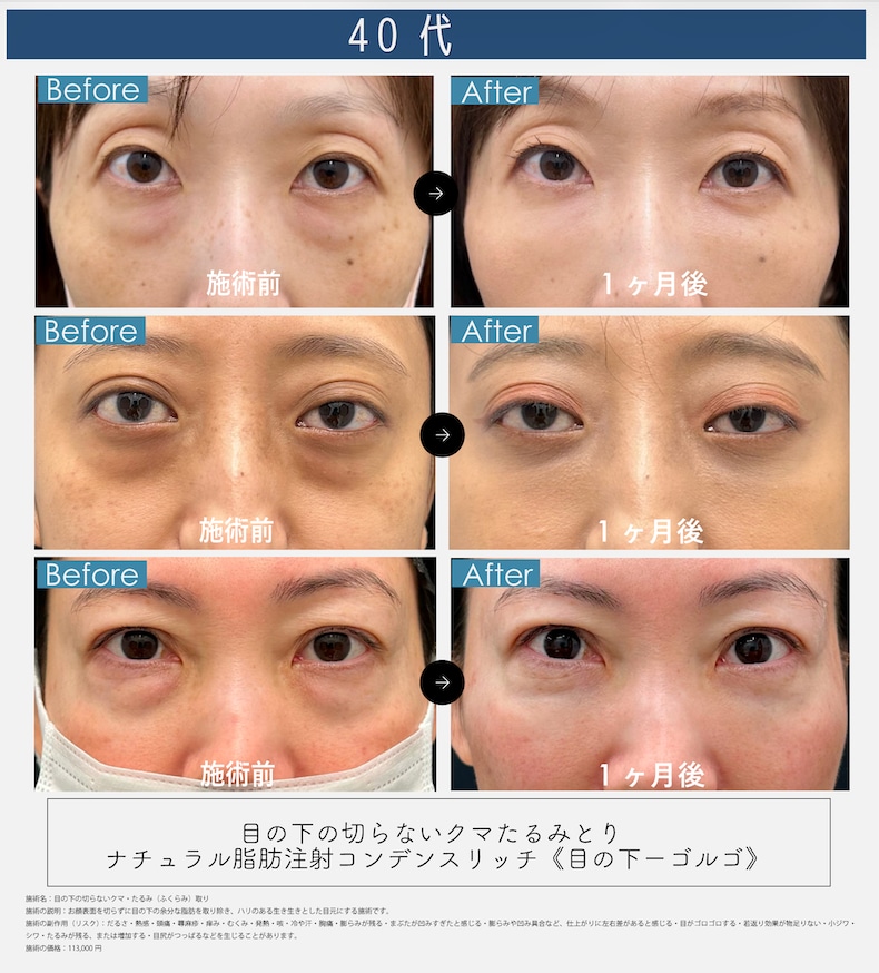 📸40代のクマ取り症例写真📸