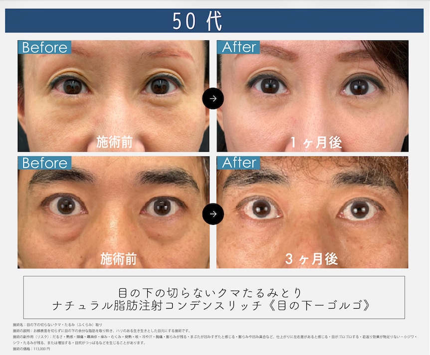 📸50代のクマ取り症例写真📸