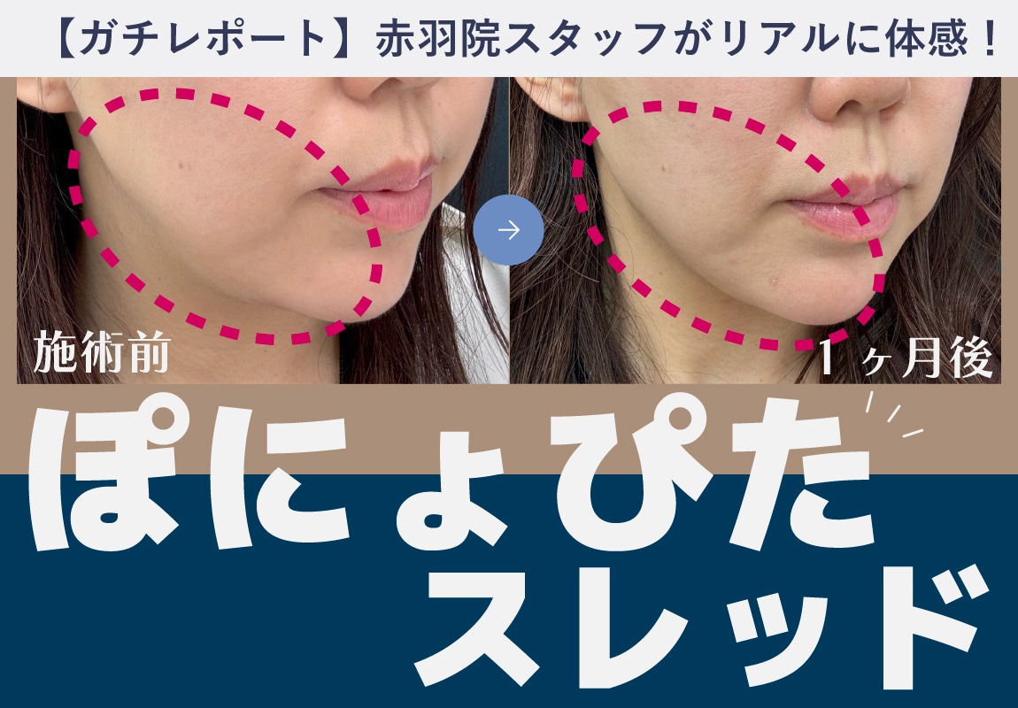 《実録》赤羽院PR担当のリアルレポート！新治療〈ぽにょぴたスレッド〉で切らないたるみ治療【赤羽駅1分】