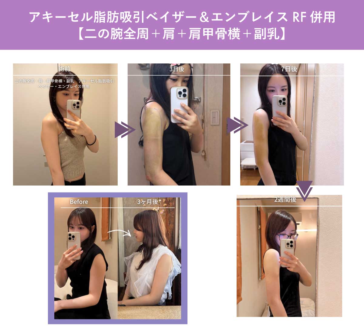 リアル経過【二の腕】