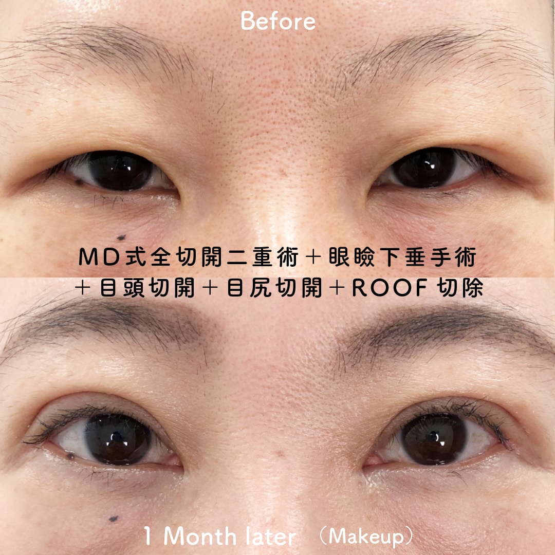 MD式全切開二重術+眼瞼下垂手術+目頭切開+目尻切開+ROOF切除の症例