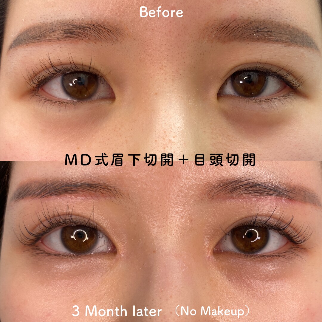 MD式眉下切開+目頭切開の症例