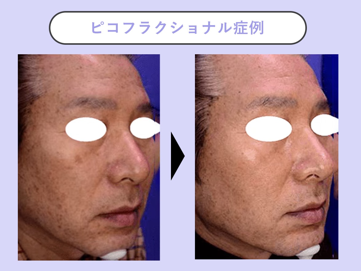 ピコフラクショナルの症例