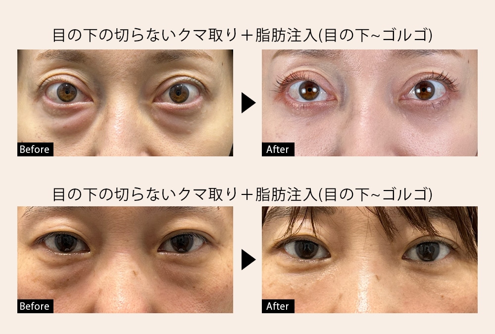 クマ取り40代