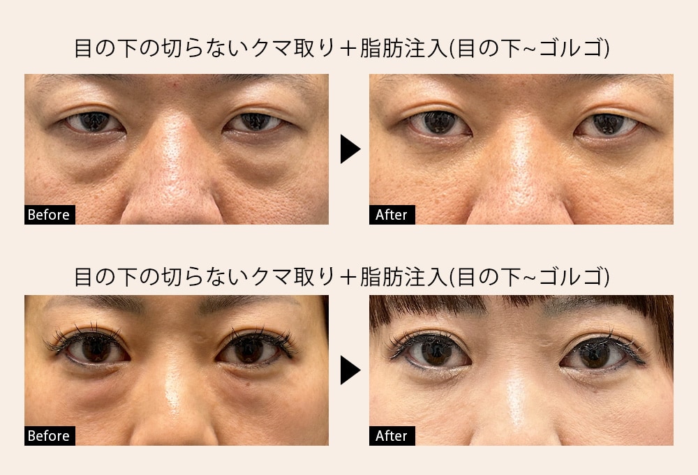 クマ取り30代
