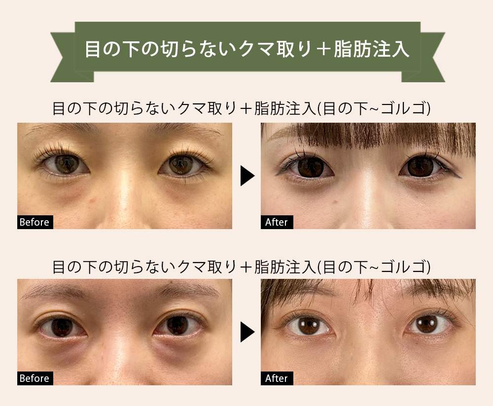 クマ取り20代