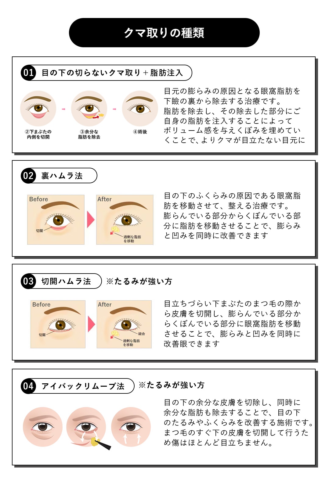 クマ取りは1種類だけじゃない！<br />
