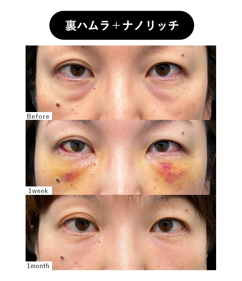 40代女性 クマとり症例