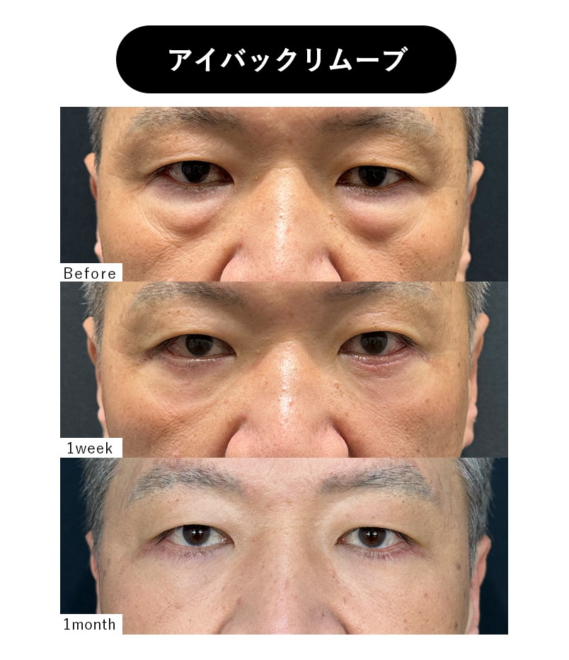 40代男性 クマとり症例