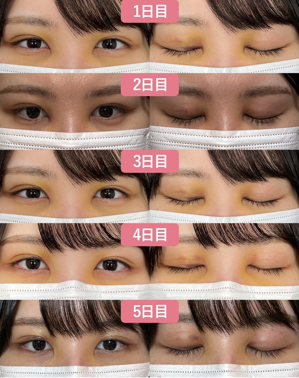1~5日目の経過