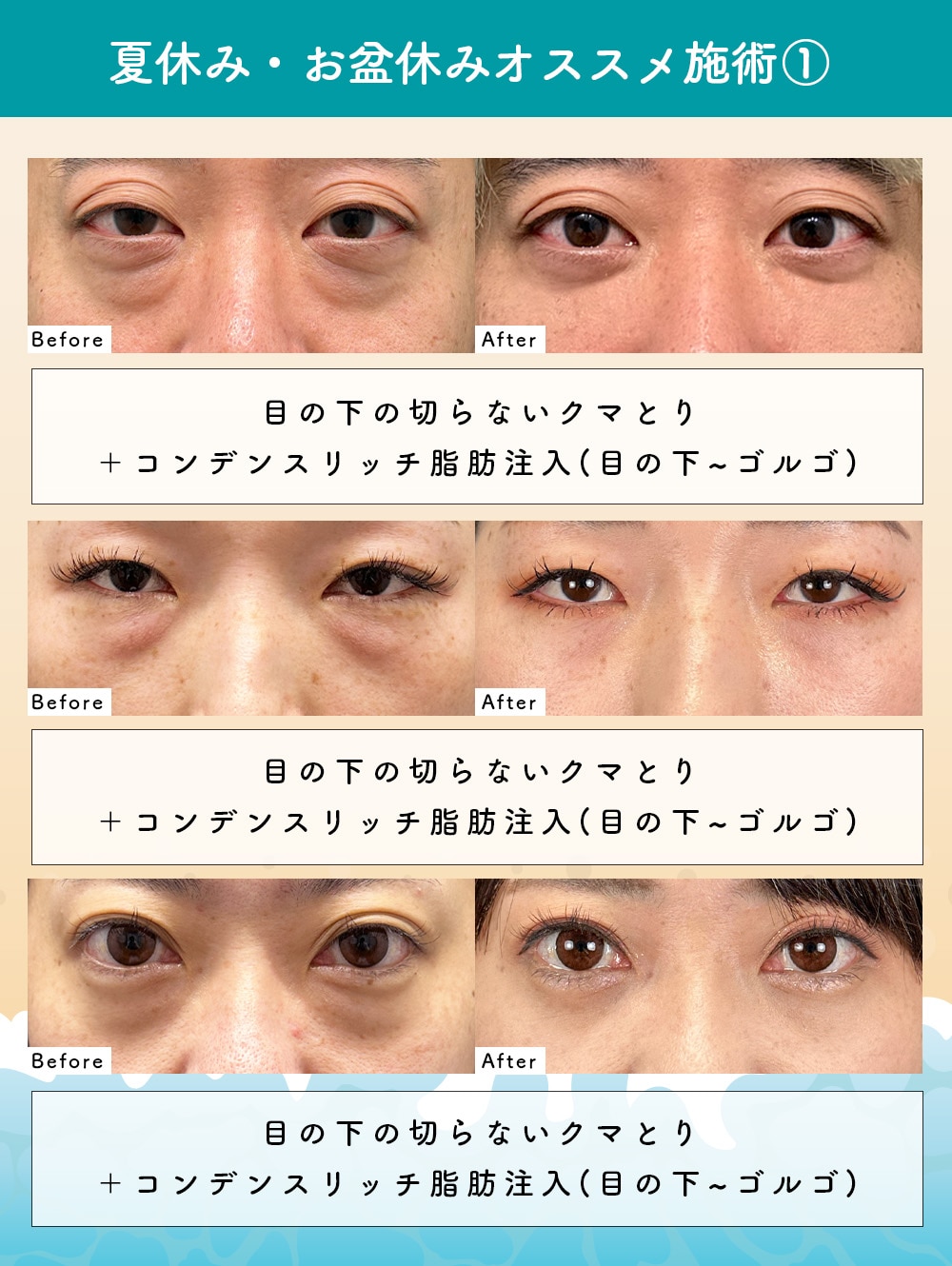 ①クマとり