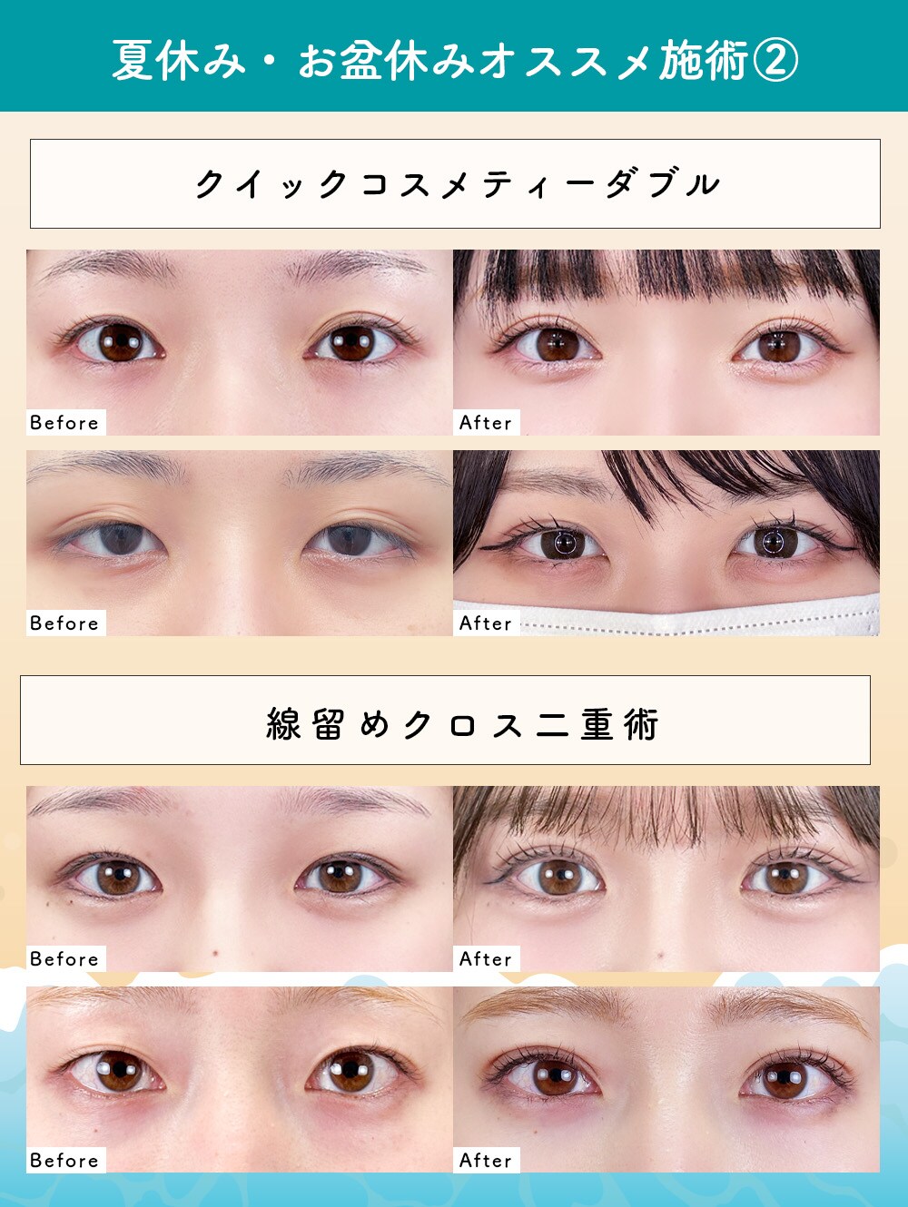 ②二重整形