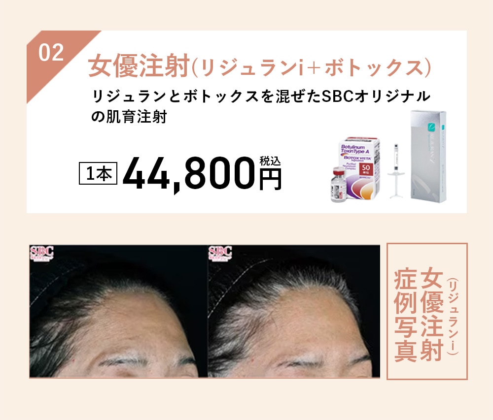 女優注射(リジュランi＋ボトックス)