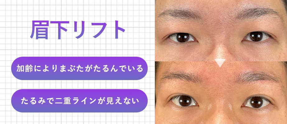 眉下リフト