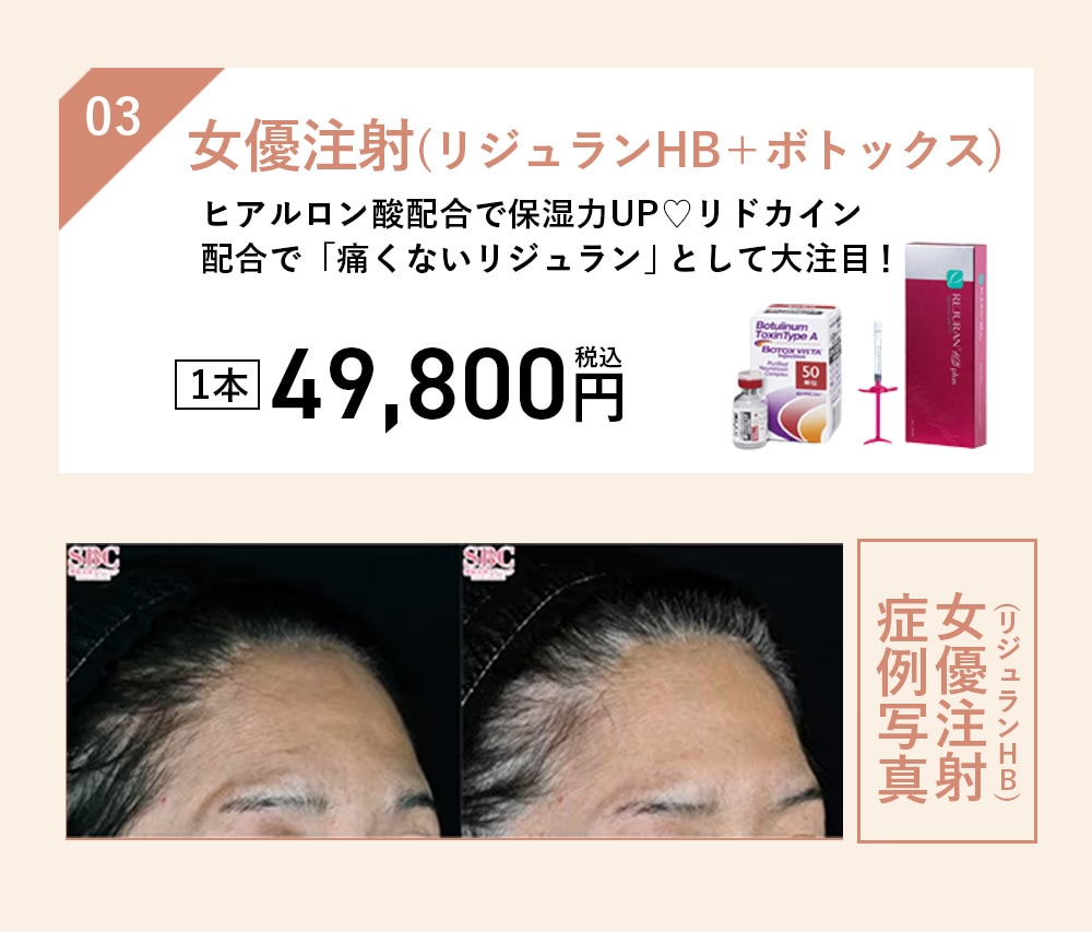 女優注射(リジュランHB＋ボトックス)