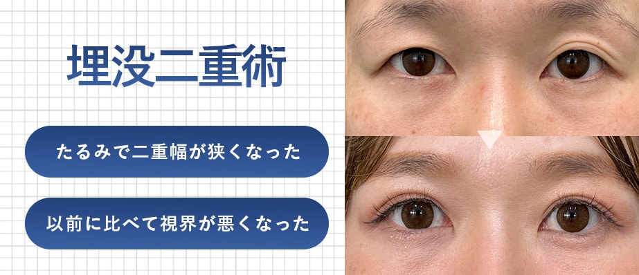 埋没二重術(切らないまぶたのリフトアップ)