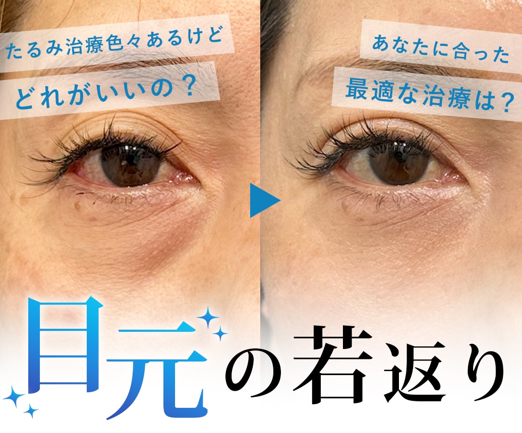 【目元の若返り特集】色々あるけどどれが良いの？まぶたのたるみ・目元の小じわはSBC明石院で！