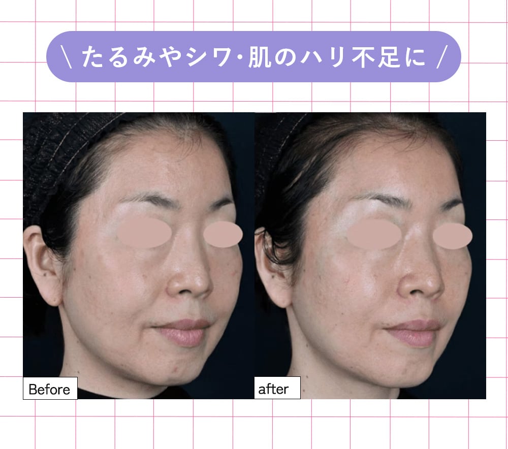 ④DENSITY(デンシティ)