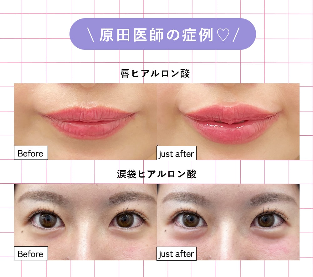 ③ヒアルロン酸