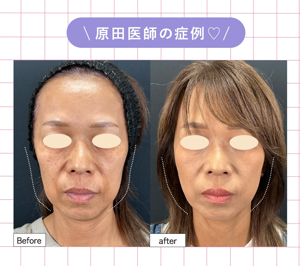 ①糸リフト<br />
