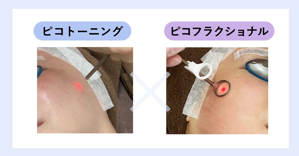 毛穴×シミにWアプローチ！ピコダブル✨