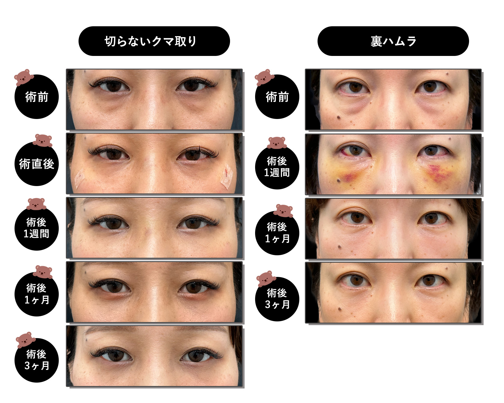 クマ取りのダウンタイムの経過