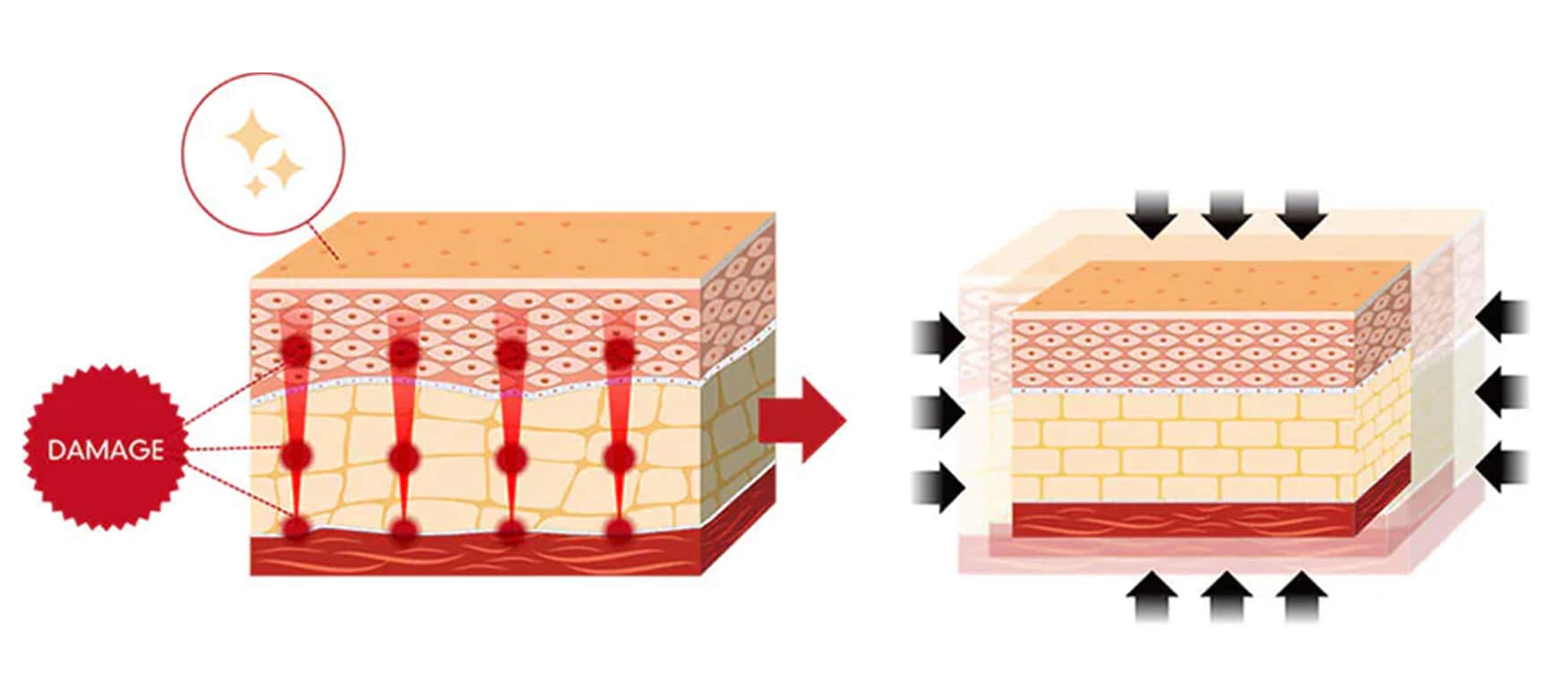 照射するだけでまるで脂肪吸引のような変化！<br />
