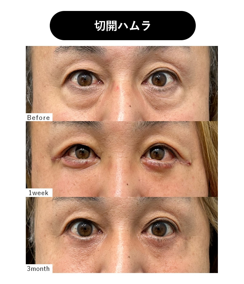 50代男性 クマとり症例