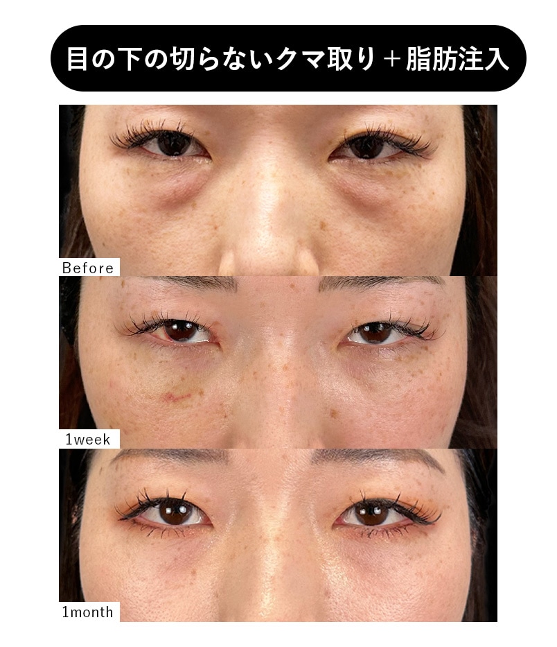 30代女性 クマとり症例