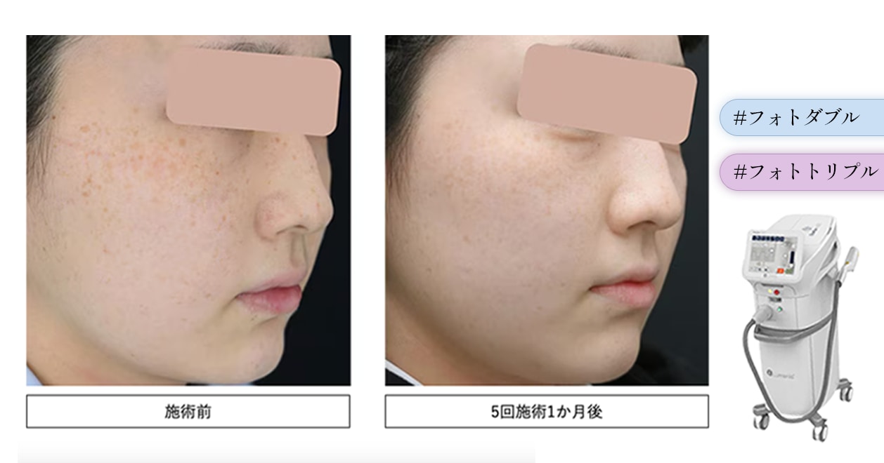 まるで韓国人のような透明感のある肌に