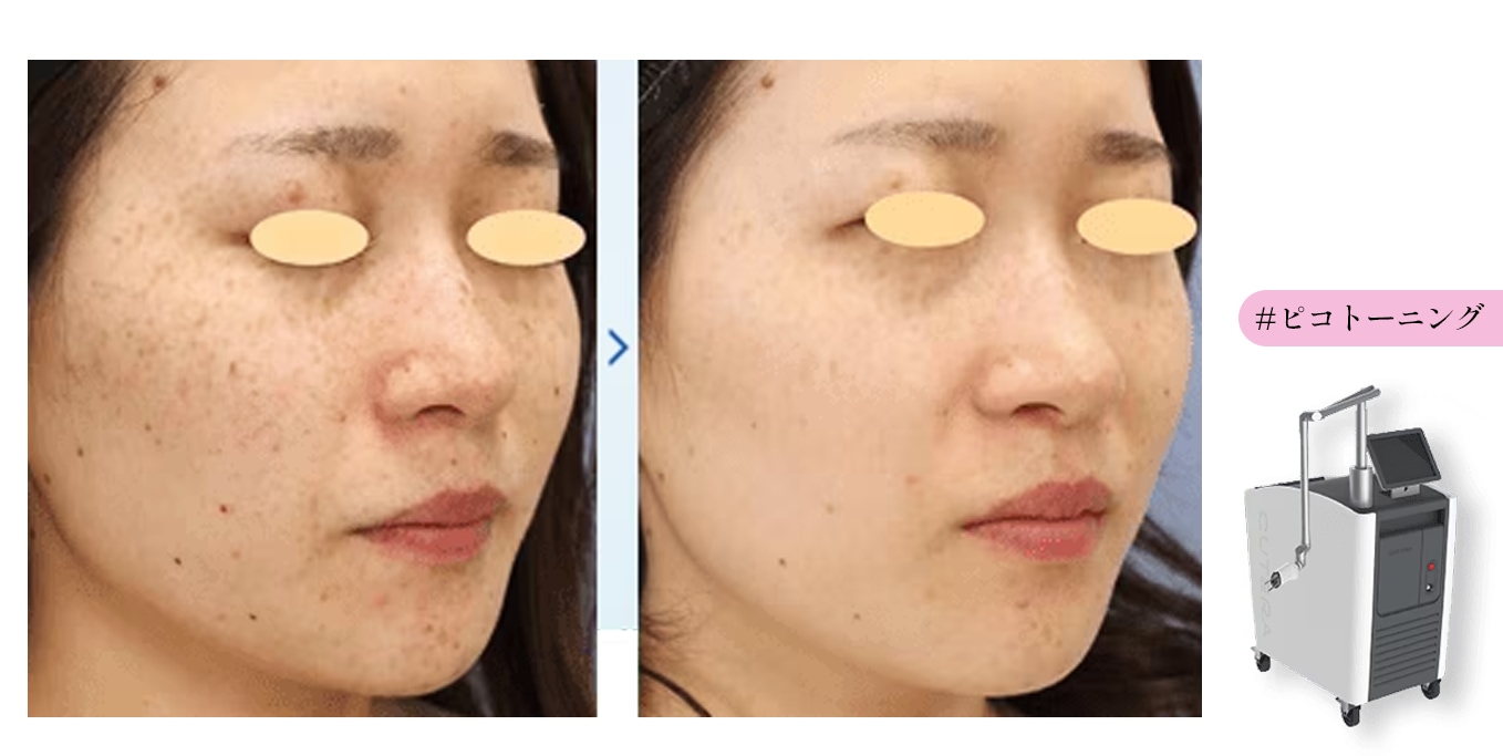 シミ・くすみ・そばかすにも