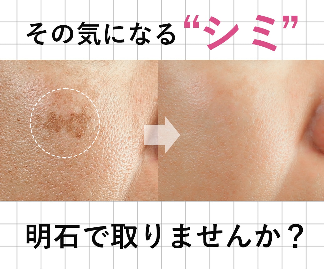 シミ取り2,680円~｜美白治療 – シミ・肝斑・そばかす治療ならSBC明石院
