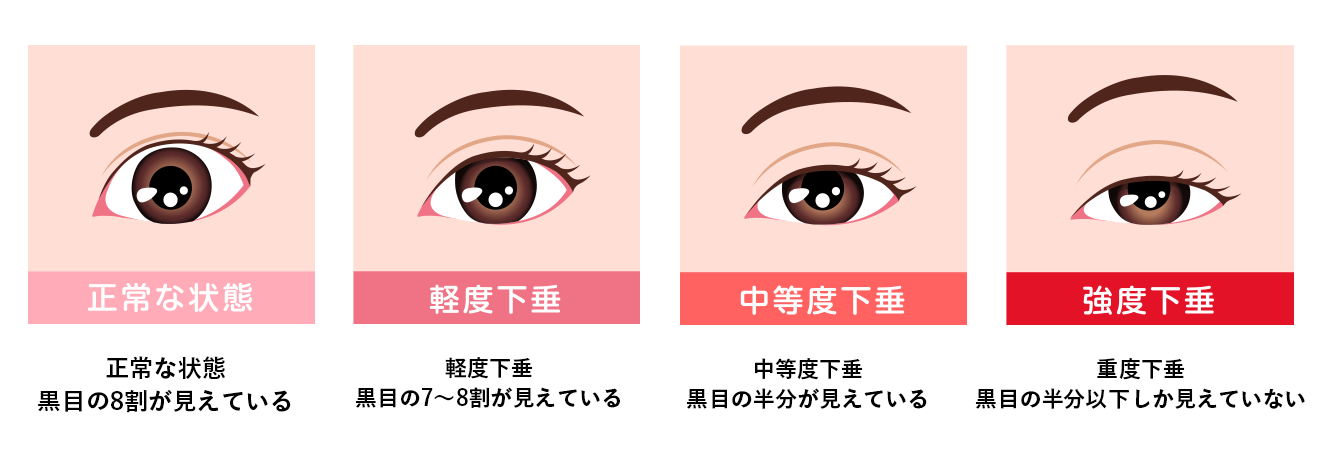 そもそも眼瞼下垂って？