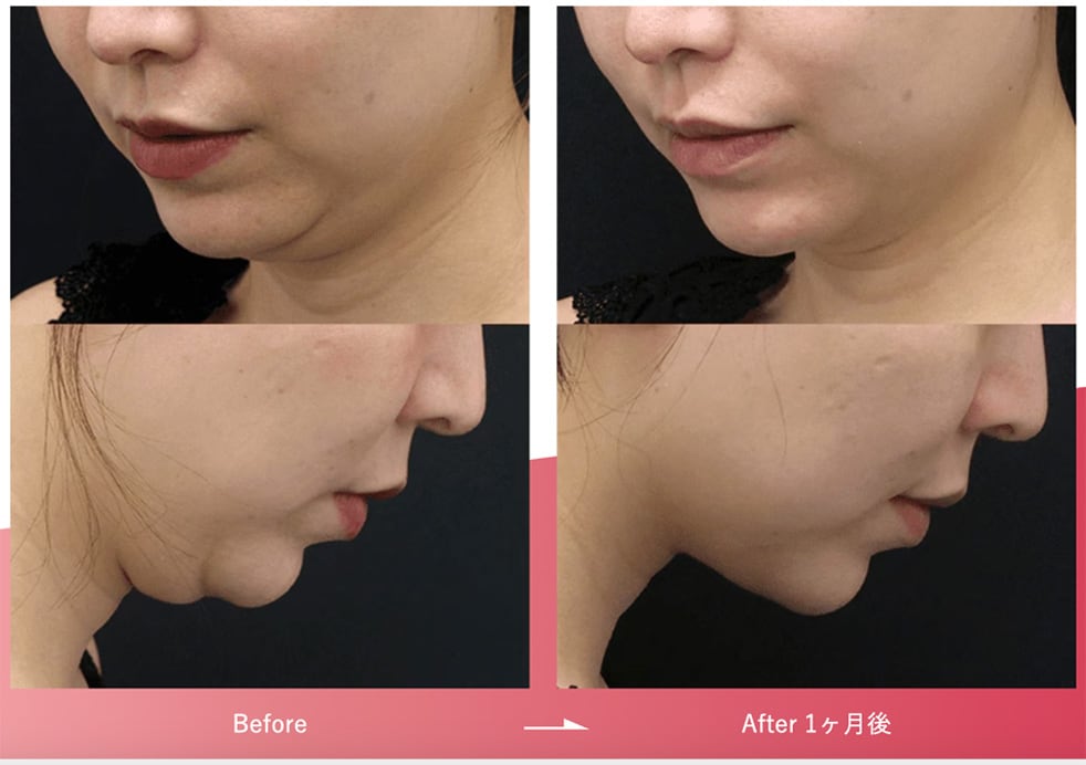 切らないのにここまで改善！