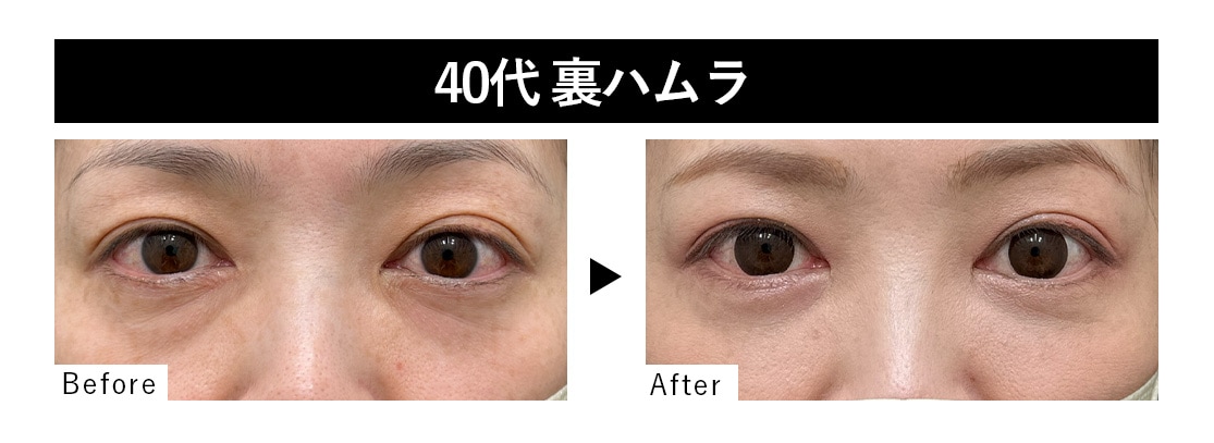 裏ハムラ症例 : 40代 ・女性