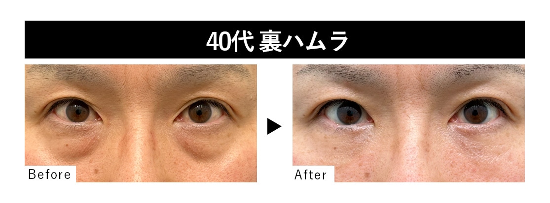 裏ハムラ症例 : 40代 ・男性