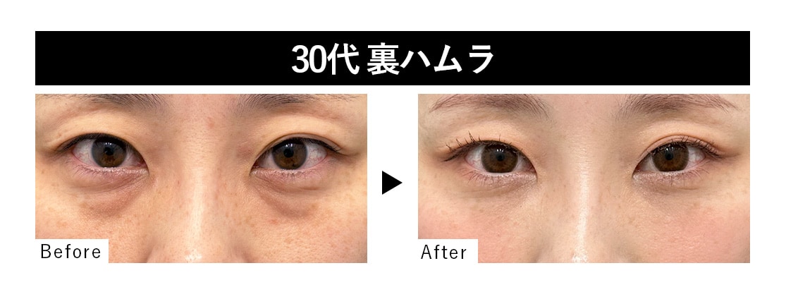 裏ハムラ症例 : 30代 ・女性<br />
