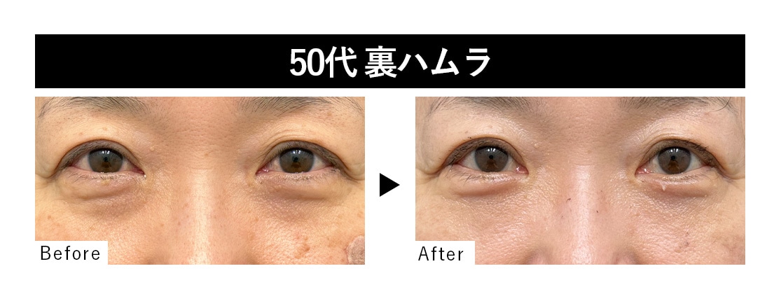 裏ハムラ症例 : 50代 ・女性