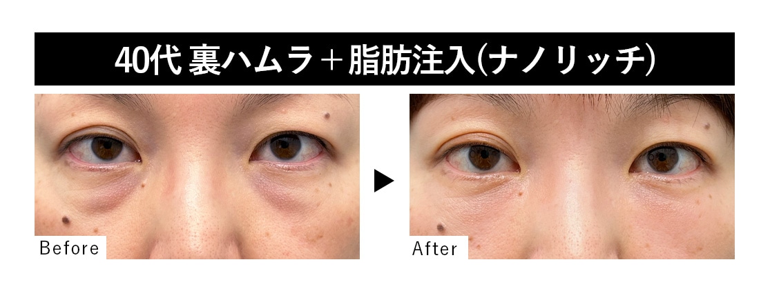 裏ハムラ＋脂肪注入(ナノリッチ)症例 : 40代 ・女性