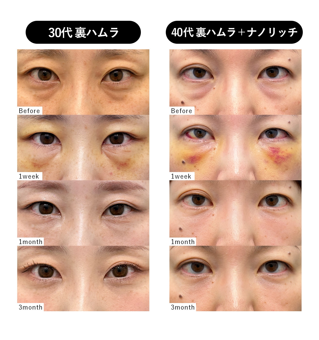 裏ハムラ単体と脂肪注入併用