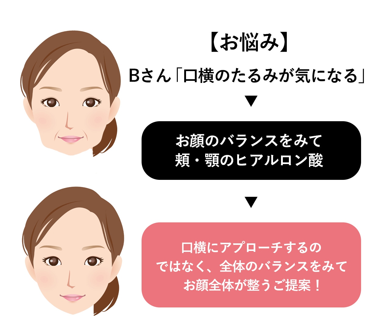 「口横のたるみが気になる」とご来院のお客様
