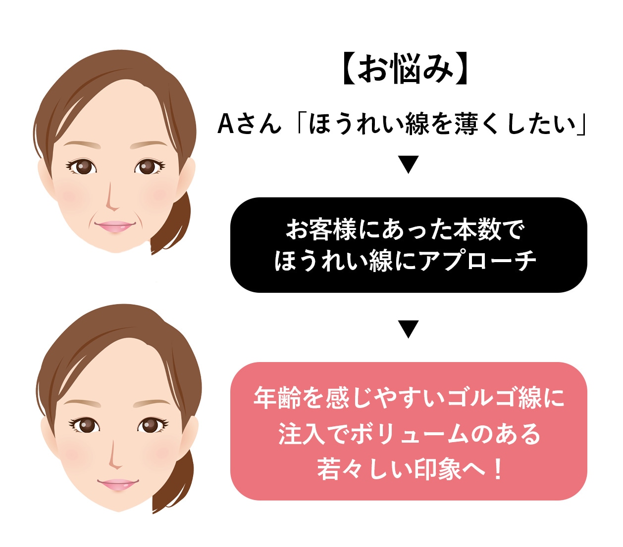 「ほうれい線を薄くしたい」とご来院のお客様