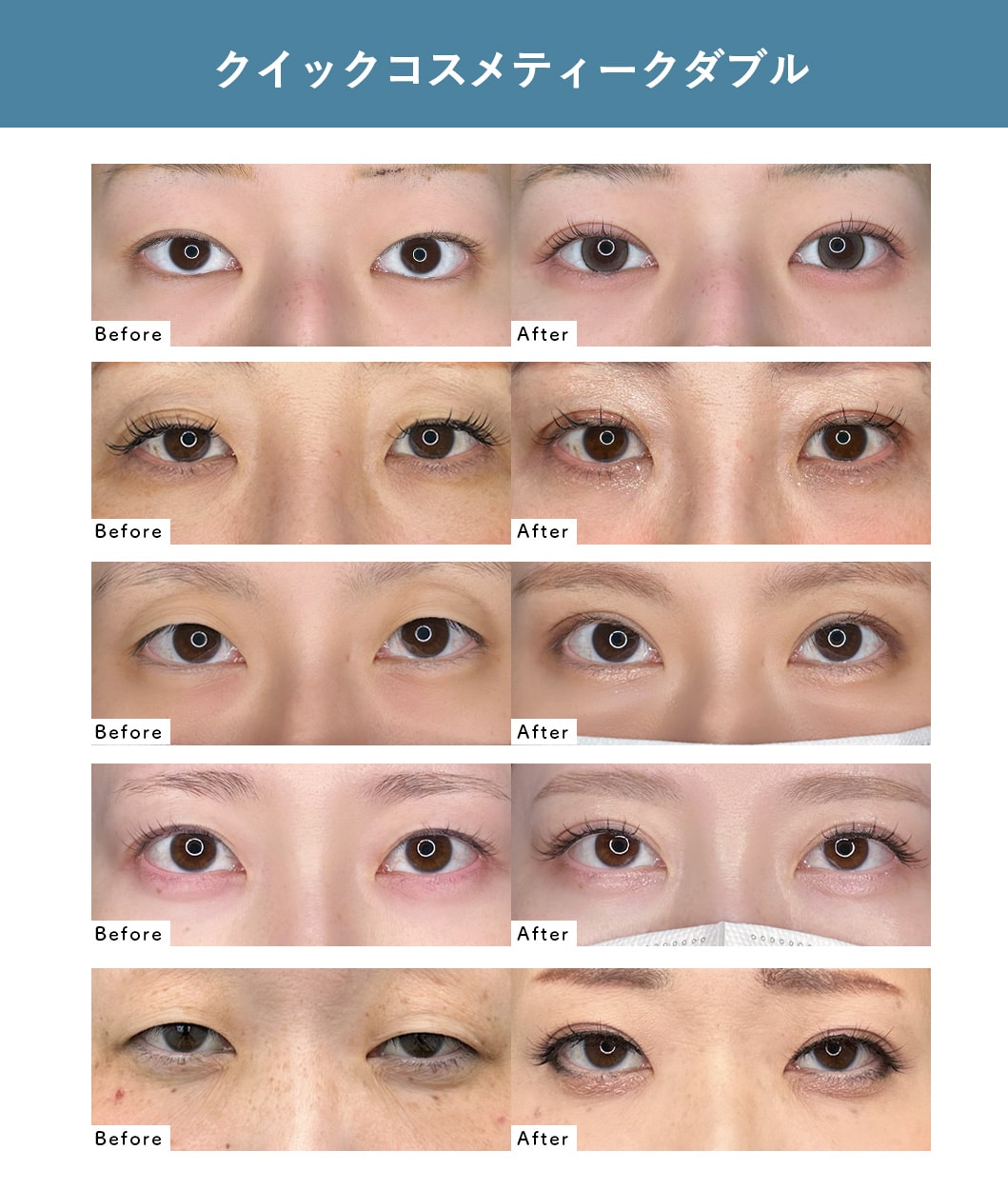 1.二重整形<br />
