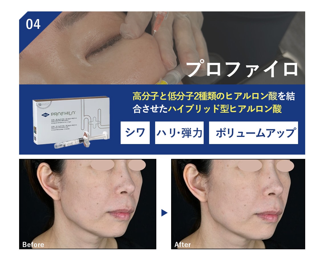 04 プロファイロ