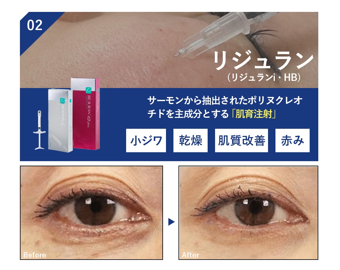 02. リジュランi・リジュランHB